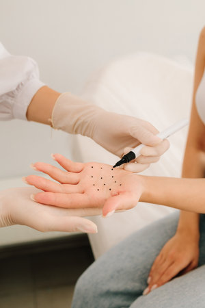 Care of palm sweating. Marking dotes for filler injection on the palm of a patient against hyperhidrosis. Markup of the hyperhidrosis treatmentの写真素材