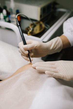 Radiofrequency mole removal under clinical conditions. dermatologist performs precise radio wave...