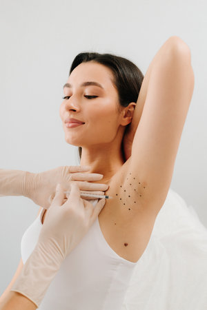 Intradermal injection procedure for underarm hyperhidrosis. Cosmetologist performing botulinum toxin injections in a woman underarm to manage excessive sweating. Hyperhidrosis injection for underarmの写真素材