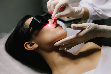 Laser therapy eliminates nevi, papillomas, and other cutaneous lesions. Laser excision of benign neoplasms on the face. Laser removal of nevi and fibromas close-upの写真素材