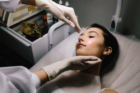 Dermatologist performs precise laser removal of a facial nevus and other benign lesions. Laser dermatologic treatment for nevus and mole removal. Aesthetic laser removal of nevi and benign growthsの写真素材