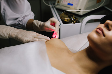 Laser excision of benign neoplasms on the body. Laser removal of nevi and fibromas close-up. Laser therapy eliminates nevi, papillomas, and other cutaneous lesionsの写真素材