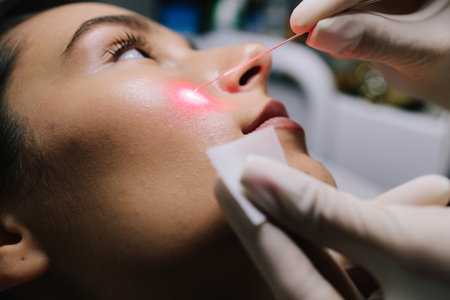 Aesthetic laser removal of nevi and benign growths. Dermatologist performs precise laser removal of...