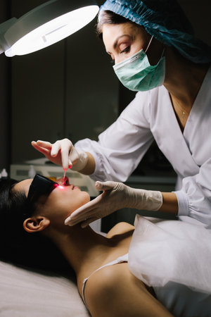 Aesthetic laser removal of nevi and benign growths. Dermatologist performs precise laser removal of a facial nevus and other benign lesions. Laser dermatologic treatment for nevus and mole removalの写真素材