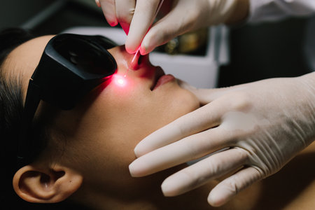 Laser excision of benign neoplasms on the face. Laser removal of nevi and fibromas close-up. Laser therapy eliminates nevi, papillomas, and other cutaneous lesionsの写真素材