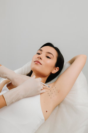 Intradermal injection procedure for underarm hyperhidrosis. Cosmetologist performing botulinum toxin injections in a woman underarm to manage excessive sweating. Hyperhidrosis injection for underarmの写真素材