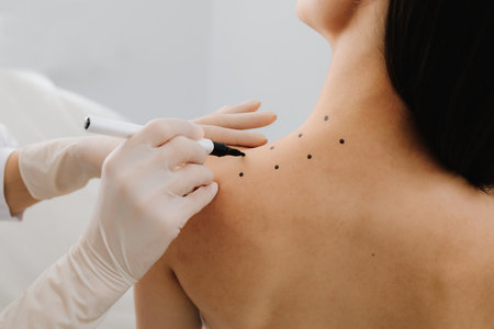 Markup skin from migraine and pain for therapy. Doctor draws markings on the skin of the back for migraine treatmentの写真素材