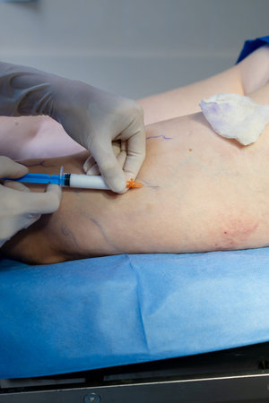 Vascular specialist performing sclerotherapy injections to restore leg vein health