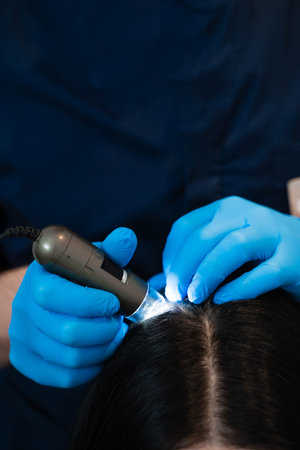 Hair and scalp analysis with digital trichoscope in trichology examinationの写真素材