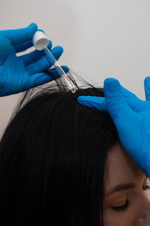 Trichologist applies serum to enhance hair follicle recovery after mesotherapyの写真素材