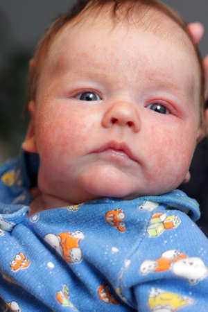 The baby has eczema on his faceの写真素材