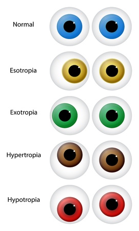 Illustration Of Different Eye Disorders. Gaze disorders or ocular misalignment disorders (strabismus) include: esotropia, exotropia, hypertropia and hypotropia.のイラスト素材