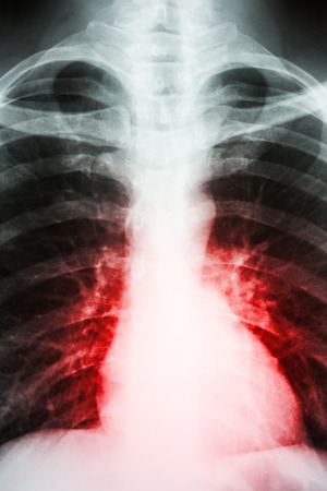 Heart Disease Symptom On Patient X-Rayの写真素材