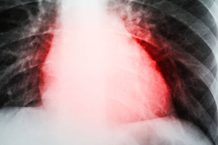 Heart Attack On Patient X-Rayの写真素材