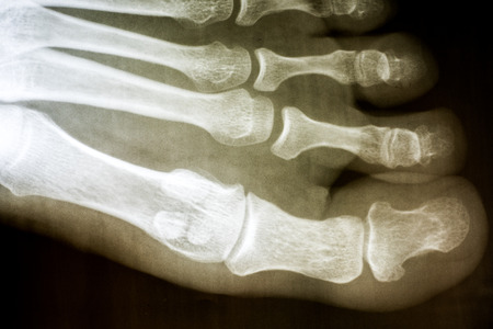 Human Foot X-Ray On Black Background