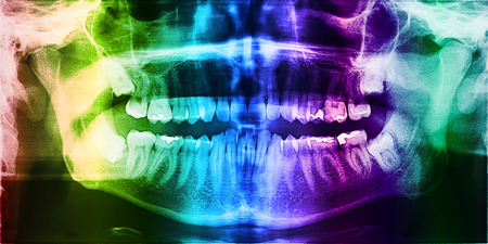 Dental X-Ray Photo Of Human Skull With Teeth