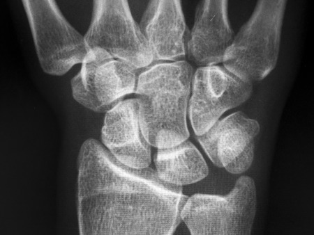 X-Ray Of Carpal And Metacarpal Bones In The Human Handの写真素材