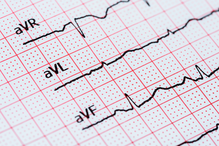 Sinus Heart Rhythm On Electrocardiogram Record Paper Showing Normal P Wave, PR and QT Interval and QRS Complexの写真素材