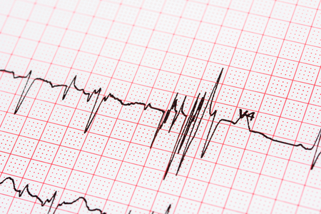 Extrasystoles On Electrocardiogram Record Paperの写真素材