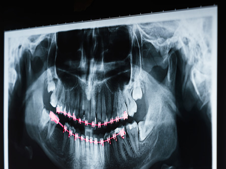 Dental X-Ray Photo Of Human Skull And Teeth With Braces