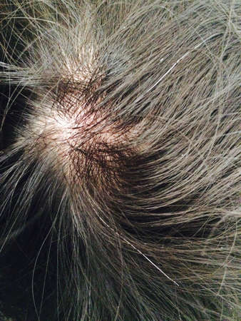 Skin hair has white and black hair on head