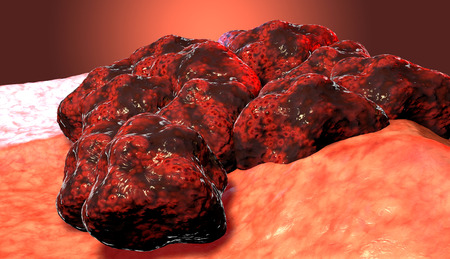 Cancer cell tumor, 3d medical illustrationの写真素材