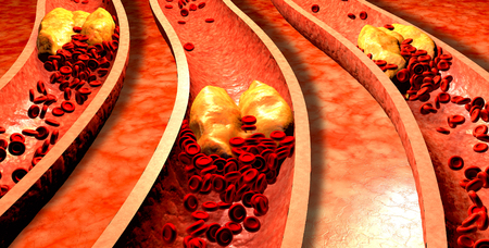 Clogged Artery with platelets and cholesterol plaque, concept for health risk for obesity or dieting and nutrition problemsの写真素材