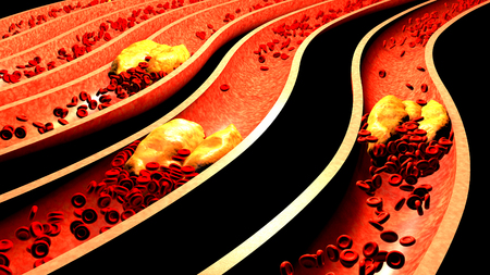 Clogged Artery with platelets and cholesterol plaque, concept for health risk for obesity or dieting and nutrition problemsの写真素材