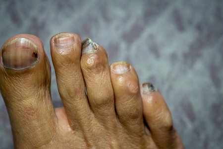 Male foot with fungal infection toenailsの写真素材
