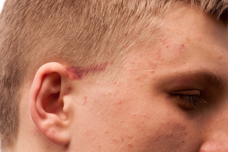 Young guy with injured face close-upの写真素材
