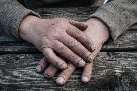 Fungus Infection on Nails Hand elderly manの写真素材