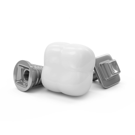Tooth Implant isolated on white background