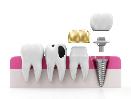 Dentistry Concept. Health Tooth, Teeth with Caries, Golden Dental Crown and Implant isolated on white backgroundの写真素材