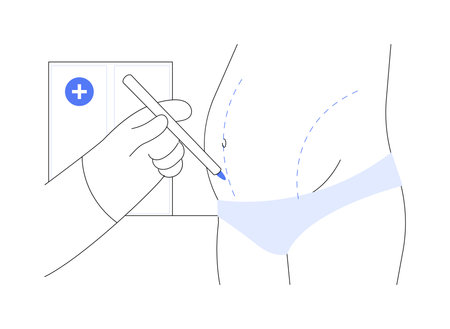 Abdominoplasty abstract concept vector illustration.のイラスト素材