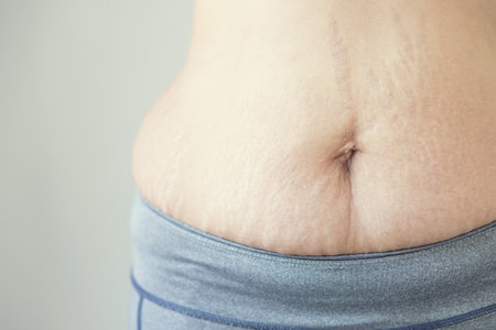Striped Belly Pattern fat stomach woman or abdominal scar marked pattern skin from pregnant have a child.の写真素材