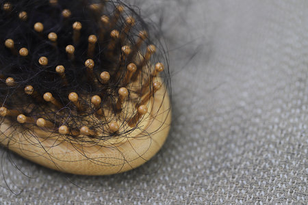 Women with hair loss dryness and frizzinessの写真素材