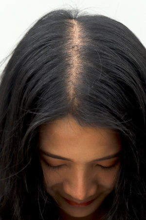 Women with hair loss dryness and frizzinessの写真素材