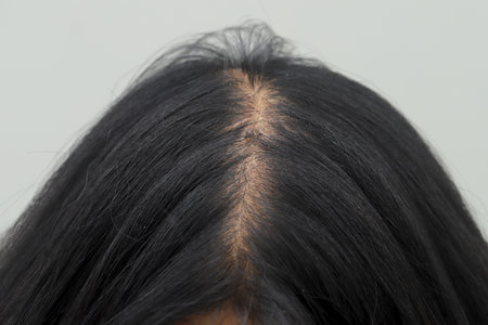 Women with hair loss dryness and frizzinessの写真素材