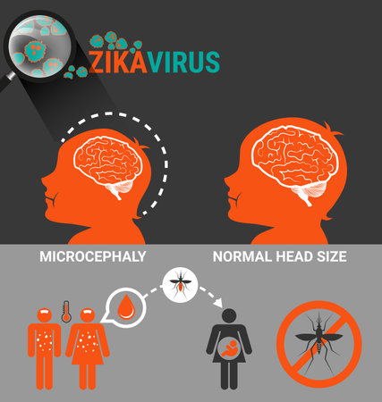 Pregnant Women with baby microcephaly and Zika Virus Infectionのイラスト素材