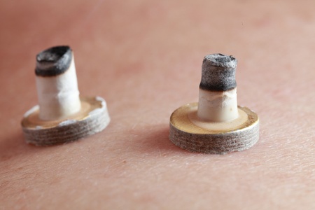 Macro image of adhesive moxa burning on the skin of a pacient.の写真素材