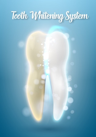 Illustration of 3D Realistic  Tooth Cleaning Process.  Teeth Cleaning Healthcare Stomatology Procedureのイラスト素材