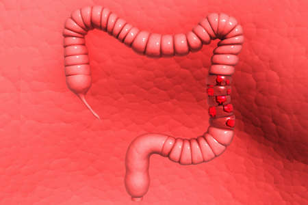 Colon cancer	