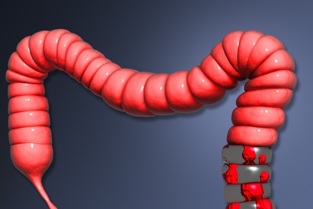 Colon cancer	
