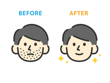 Beard hair removal, before and after icon (line drawing color) illustrationのイラスト素材