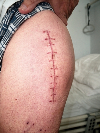 Scar following surgery of hip joint. Replacing of the devastated hip joint for the hip...