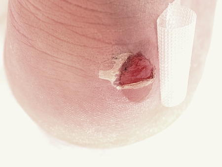 Wet bloody painful skin on man foot with adhesive plaster..
Achilles heel wound with bandage. Craced terrible blister on human heel.の写真素材