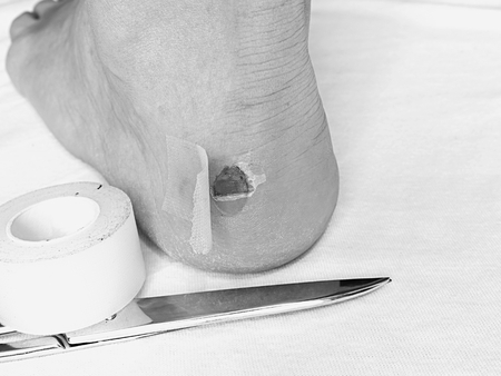 Heel wound,  stick bandage and  scissors.  Craced terrible blister on human heel. Wet bloody painful skin on man foot with adhesive plaster.の写真素材