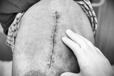 Old Human leg with postoperative scar of hip joint surgery. Selective focus of male body. Heart disease. Medical conceptの写真素材