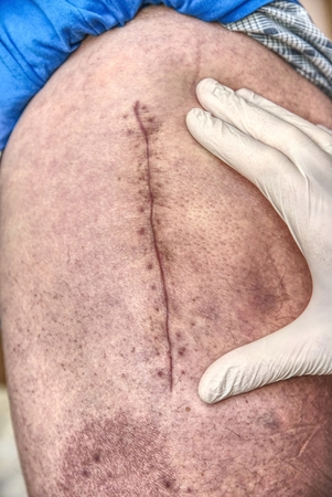 Patient with a fresh long scar after a hip surgery. Macro,  Human leg with bloody scar from hip...