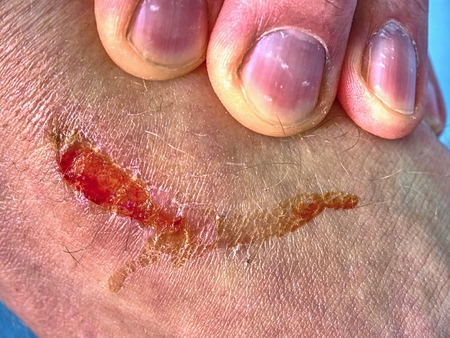 Doctors hand healing a burned skin area.  Hand embracing injured  place with painful abrasion...